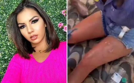 Influencer tem perna queimada após mulher acender churrasqueira