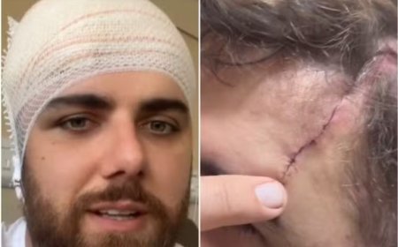 Cantor Zé Neto mostra corte na cabeça após acidente