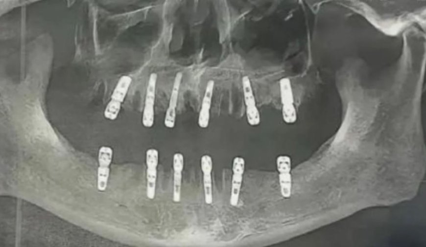 Homem morre após extrair 23 dentes e implantar 12 em uma única cirurgia