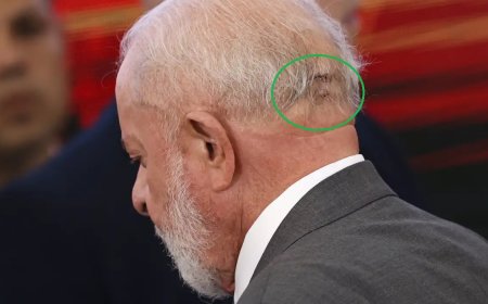 Lula vai a hospital e retira pontos de corte após queda