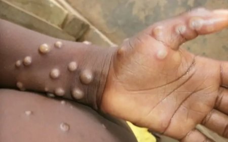 Brasil registra mais de 1,5 mil casos de Mpox em 2024
