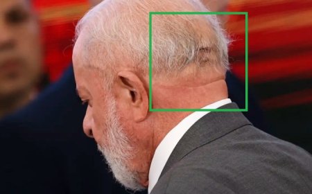 Lula deixa UTI e passa a ter cuidados semi-intensivos no hospital