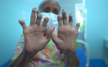 Divulgadas regras para pensão de filhos de isolados por hanseníase