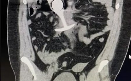 Mulher fica gravemente ferida após brinquedo sexual ser 'arrastado para dentro de seu corpo' durante ressonância magnética