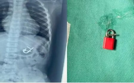 Criança de quatro anos é atendida em hospital após engolir cadeado com as chaves