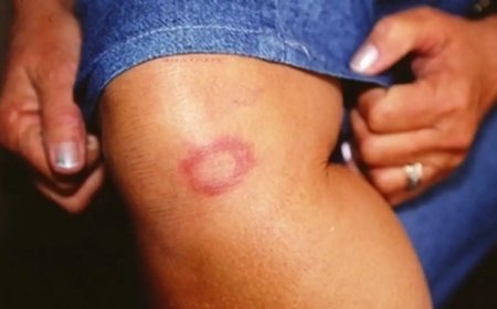 Hanseníase: conheça verdades e mitos sobre a doença