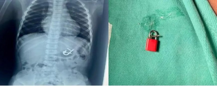 Criança de quatro anos é atendida em hospital após engolir cadeado com as chaves