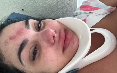Empresária sofre fratura na coluna após cabelo ser sugado por bomba de piscina no RS