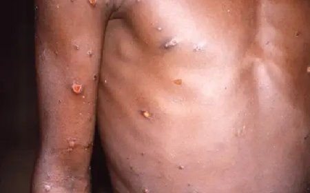 Mpox: conheça os primeiros sinais e sintomas da doença