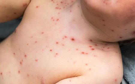 Distrito Federal registra primeiro caso de sarampo desde 2020