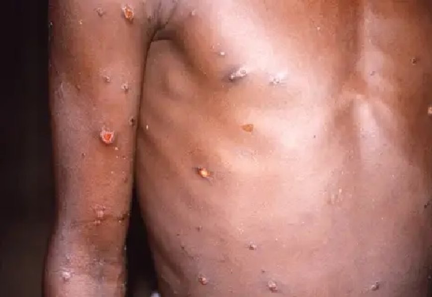 Mpox: conheça os primeiros sinais e sintomas da doença