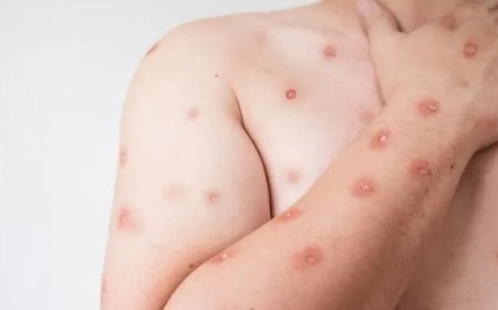 Mpox: o que é a doença, como se transmite e como se proteger