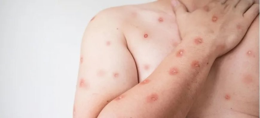 Mpox: o que é a doença, como se transmite e como se proteger