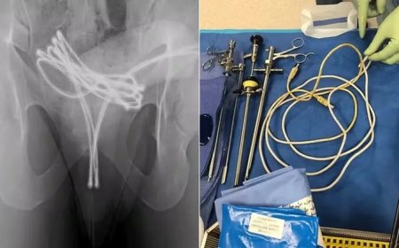 Homem é internado após enfiar cabo de carregador na uretra e objeto ficar preso