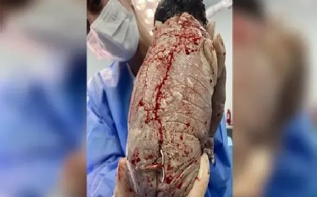 Bebê nasce com DIU colado ao corpo e surpreende equipe médica: “Quando é pra ser, não há método que impeça”