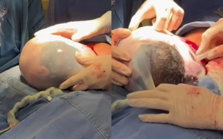 Gêmea nasce empelicada e cena rara emociona