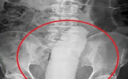 Homem dá entrada com objeto preso no ânus, passa por cirurgia e foge de hospital