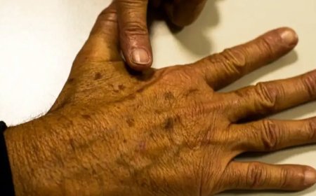 Casos de câncer de pele em idosos dispararam nas últimas três décadas