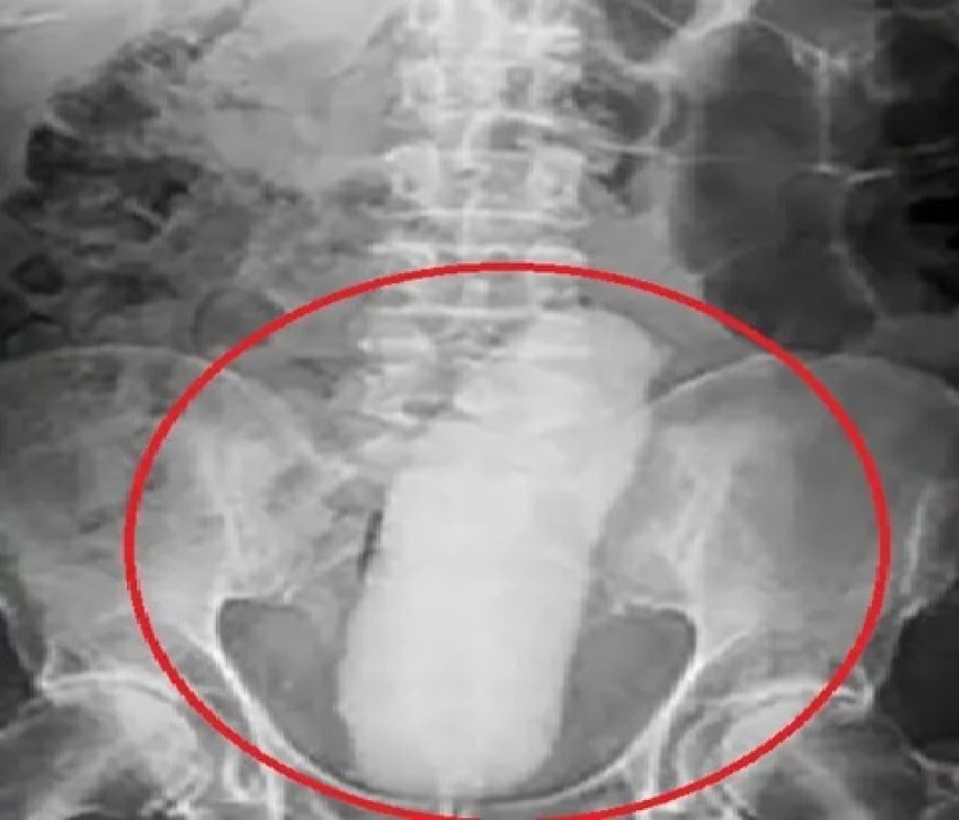 Homem dá entrada com objeto preso no ânus, passa por cirurgia e foge de hospital