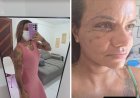 Vítima de agressão com 61 socos compartilha rotina de recuperação nas redes sociais
