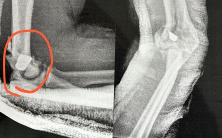 Cantor gospel está com bala no braço e fará cirurgia de risco; veja raio-X