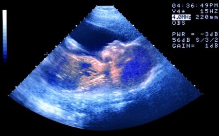 Bebê nasce de embrião congelado há 30 anos e bate recorde mundial