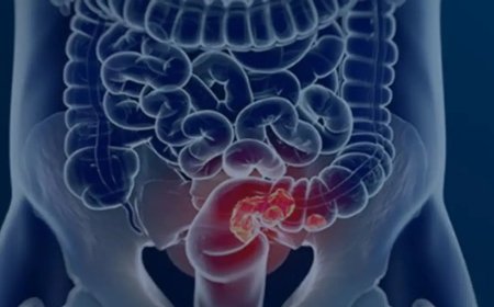Estudo projeta aumento de 36% em mortes por câncer colorretal até 2040