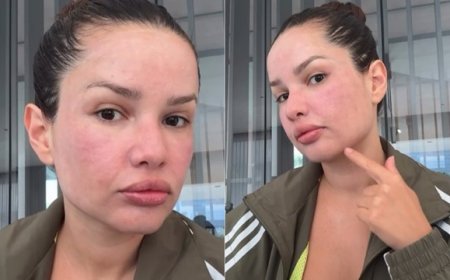 Juliette mostra rosto inchado após tratamento com esperma de salmão: veja