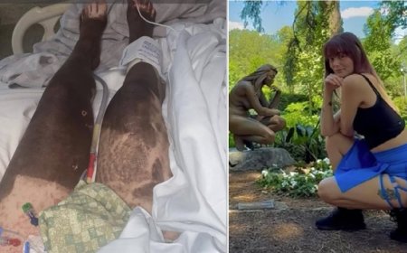 Mulher tem reação grave a ibuprofeno e 95% da pele se solta do corpo