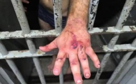 Veja como ficou a mão de ex-jogador após agredir mulher com 61 socos