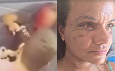 Mulher espancada com mais de 60 socos no elevador mostra rosto após cirurgia de reconstrução facial