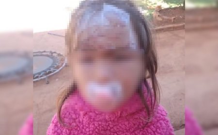 Criança de 3 anos leva 27 pontos no rosto após ataque de cachorro adotado