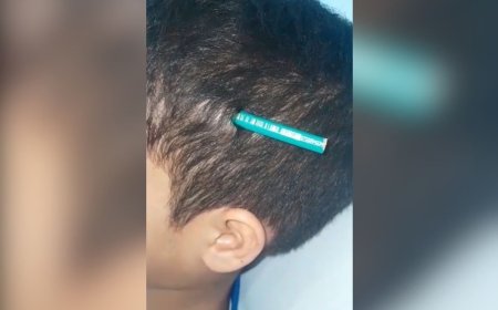 Menino tem lápis fincado na cabeça após agressão de colega em escola