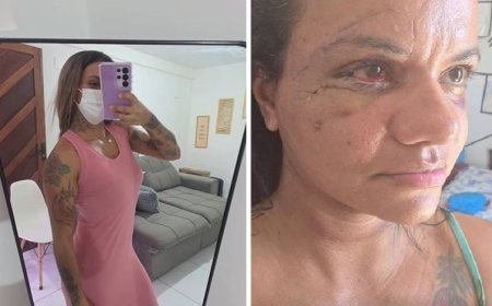 Vítima de agressão com 61 socos compartilha rotina de recuperação nas redes sociais