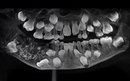 Menino de 7 anos tem 526 dentes retirados de tumor raro