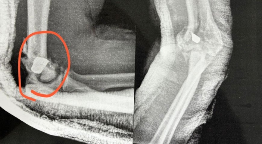 Cantor gospel está com bala no braço e fará cirurgia de risco; veja raio-X
