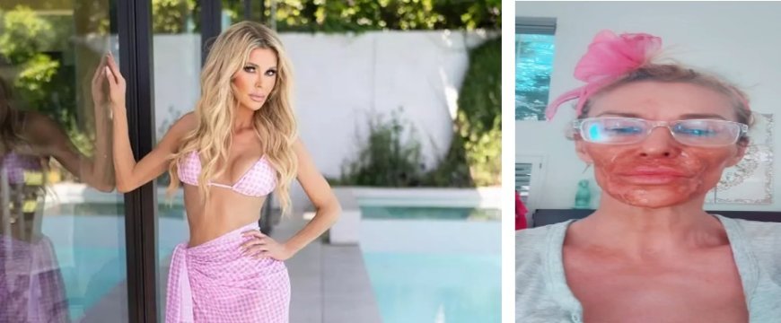 Ex-modelo tenta matar parasita no rosto e sofre graves consequências; vídeo