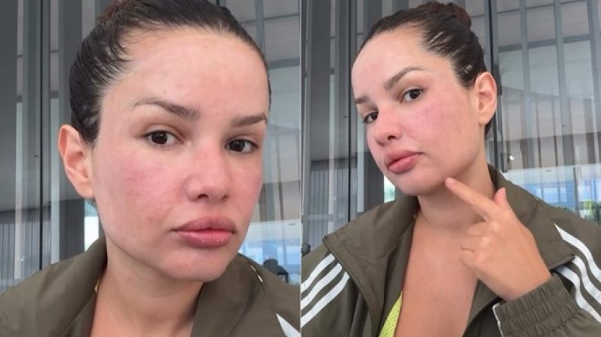 Juliette mostra rosto inchado após tratamento com esperma de salmão: veja