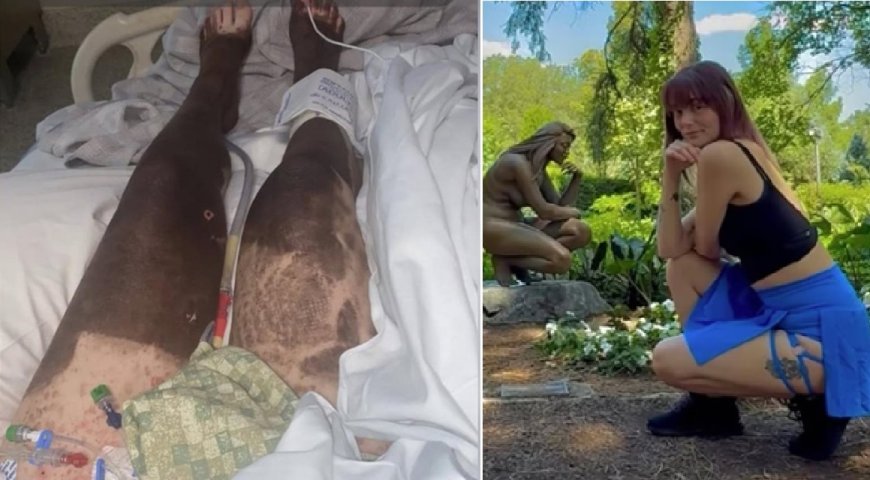 Mulher tem reação grave a ibuprofeno e 95% da pele se solta do corpo
