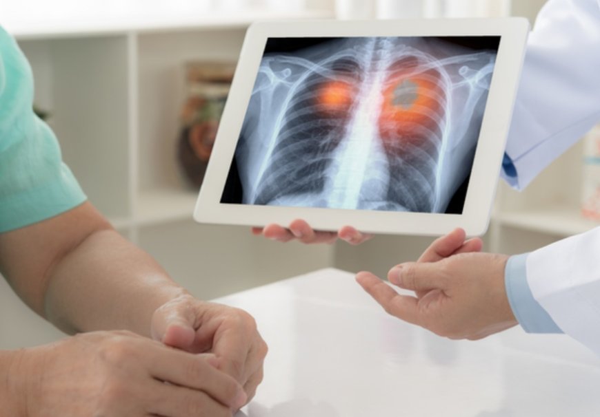 Câncer de pulmão: saiba sobre os sintomas, diagnóstico e tratamento
