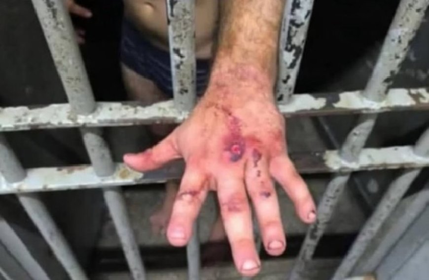 Veja como ficou a mão de ex-jogador após agredir mulher com 61 socos