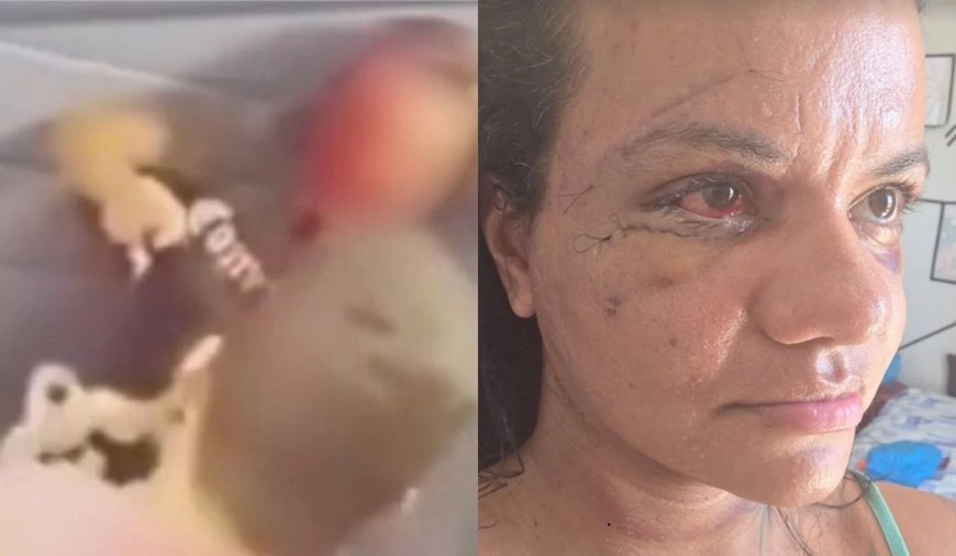 Mulher espancada com mais de 60 socos no elevador mostra rosto após cirurgia de reconstrução facial