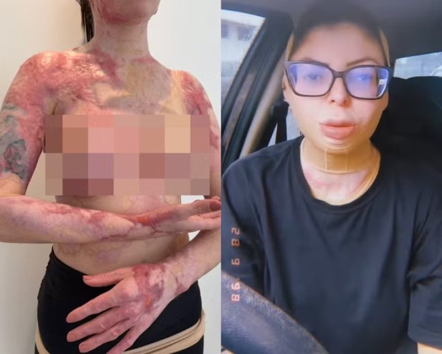 Mulher que teve 32% do corpo queimado após panela de fondue explodir em SC relata luta diária: 'Derretia como cera'