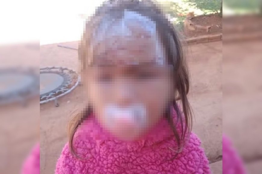 Criança de 3 anos leva 27 pontos no rosto após ataque de cachorro adotado