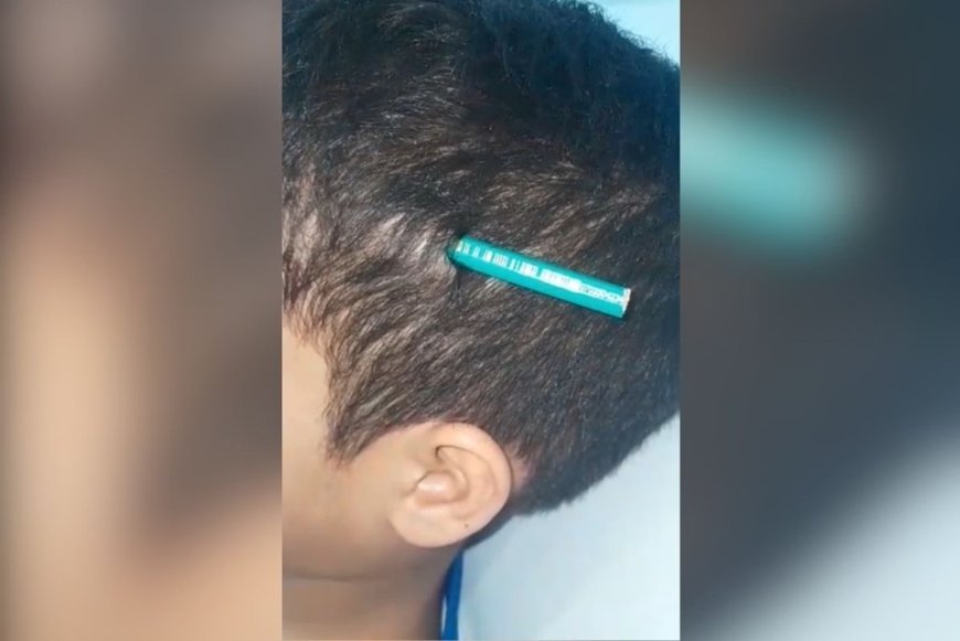 Menino tem lápis fincado na cabeça após agressão de colega em escola