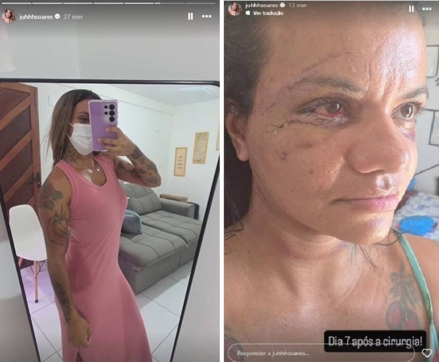 Vítima de agressão com 61 socos compartilha rotina de recuperação nas redes sociais