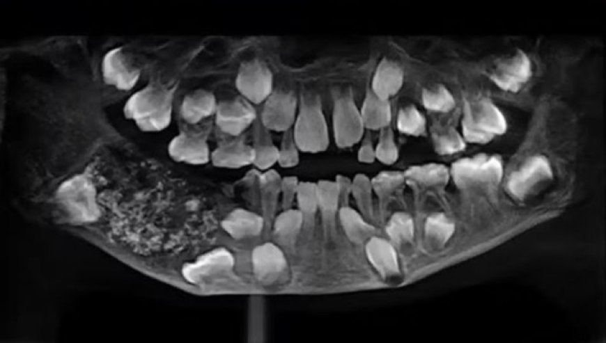 Menino de 7 anos tem 526 dentes retirados de tumor raro