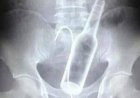 Homem passa por cirurgia após introduzir duas garrafas no ânus
