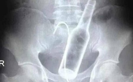 Homem passa por cirurgia após introduzir duas garrafas no ânus