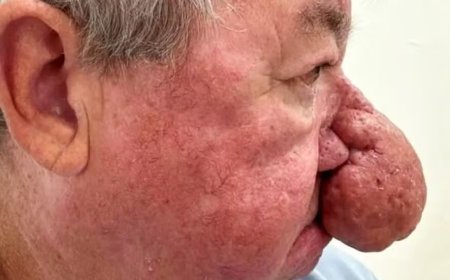 Homem com nariz gigantesco faz cirurgia para poder voltar a beijar a esposa